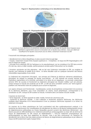 © UMVF - Université Médicale Virtuelle Francophone
Figure 9 : Représentation schématique d’un décollement de rétine
Figure 10 : Physiopathologie du décollement de la rétine (DR)
La survenue d’une déchirure en périphérie rétinienne permet le passage de liquide dans l’espace sous-
rétinien ; l’épithélium pigmentaire assure la résorption de ce liquide sous-rétinien, mais son débit est
insuffisant et le liquide s’accumule sous la rétine, entraînant l’extension du DR.
Il reconnaît trois étiologies principales :
• décollement de la rétine idiopathique, le plus souvent chez le sujet âgé,
• myopie, notamment myopie forte (myopie supérieure à – 6 dioptries) ; le risque de DR rhegmatogène croît
avec le degré de myopie,
• chirurgie de la cataracte (DR de l’aphaque ou du pseudophaque), qui se complique d’un DR dans environ
2% des cas, dans un délai variable, parfois plusieurs années après l’intervention sur le cristallin.
L’évolution spontanée est très péjorative : elle se fait vers l’extension inexorable du DR, qui englobe la
macula, puis intéresse la totalité de la rétine ; la rétine décollée subit en quelques semaines des lésions
irréversibles responsables d’une cécité.
Le traitement est uniquement chirurgical : son principe est d’obturer la déchirure rétinienne périphérique,
permettant de stopper le passage de liquide sous-rétinien ; le LSR résiduel est ensuite résorbé par
l’épithélium pigmentaire et la choroïde, permettant à la rétine de se réappliquer. Le pronostic anatomique
(environ 90% de succès) et fonctionnel du traitement chirurgical est d'autant meilleur qu'il est précoce,
surtout lorsque la macula est soulevée par le DR. Le DR est ainsi considéré comme une "semi-urgence",
justifiant une intervention dans les quelques jours suivant le diagnostic.
Les signes cliniques sont fonctionnels : myodésopsies, suivies de phosphènes correspondant à la survenue
de la déchirure rétinienne, puis d’une amputation du champ visuel périphérique, correspondant à la
constitution du DR ; lorsque le DR soulève la macula, il entraîne alors une baisse d’acuité visuelle.
L'examen du fond d’oeil :
• fait le diagnostic : la rétine apparaît en relief, mobile, formant de volumineux plis.
• recherche la déchirure causale ; il doit s’attacher à rechercher plusieurs déchirures, les déchirures
multiples étant fréquentes et la méconnaissance d’une ou plusieurs déchirures exposant à un échec du
traitement chirurgical,
Un examen de la rétine périphérique de l’oeil controlatéral doit être systématiquement pratiqué, à la
recherche de déchirure(s) non compliquée(s) de décollement de rétine ou de lésions prédisposantes (zones
de dégénérescence palissadique au niveau desquelles peuvent survenir des déchirures rétiniennes) ; ces
lésions peuvent en effet bénéficier d’un traitement préventif par photocoagulation au laser afin de diminuer le
risque de bilatéralisation du DR (risque de bilatéralisation > 10%).Ce traitement prophylactique par
photocoagulation au laser peut également se discuter, mais il est plus controversé, en l’absence de
décollement de la rétine chez des sujets porteurs de lésions de dégénéresence palissadique et par ailleurs à
risque de DR (notamment sujets myopes forts).
8
 