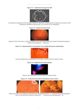 © UMVF - Université Médicale Virtuelle Francophone
Figure 11 : Traitement chirugical du DR
Le traitement chirugical du DR consiste à obturer la déchirure, ce qui permet au liquide sous-rétinien d’être
résorbé par l’épithélium pigmentaire, et à la rétine de se réappliquer.
Figure 12 : Aspect du fond d’oeil
Aspect du fond d’oeil dans un DR secondaire à une volumineuse déchirure située en temporal supérieur ;
limites du décollement :· , déchirure : .
Figure 13 : Représentation schématique d’une dégénérescence palissadique
Lésion prédisposant au décollement de la rétine, surtout chez des sujets à risque.
Figure 14 : Dégéréscence palissadique
Examen de la périphérie du fond d’oeil à la lampe à fente.
Figure 15 : Traitement préventif du décollement de la rétine
ulation préventive d’une déchirure rétinienne non compliquée de DR. - b : cicatrices de photocoagulation
atour d’une déchirure rétinienne (déchirure : , cicatrices de photocagulation : Å.)
9
 
