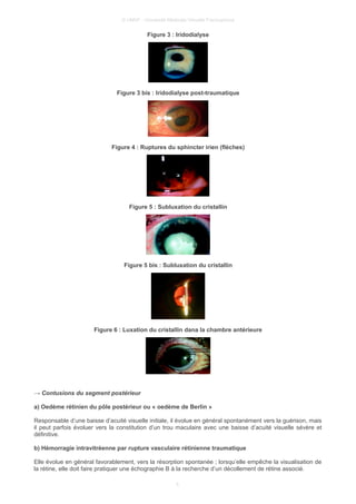 © UMVF - Université Médicale Virtuelle Francophone
Figure 3 : Iridodialyse
Figure 3 bis : Iridodialyse post-traumatique
Figure 4 : Ruptures du sphincter irien (flèches)
Figure 5 : Subluxation du cristallin
Figure 5 bis : Subluxation du cristallin
Figure 6 : Luxation du cristallin dana la chambre antérieure
→ Contusions du segment postérieur
a) Oedème rétinien du pôle postérieur ou « oedème de Berlin »
Responsable d’une baisse d’acuité visuelle initiale, il évolue en général spontanément vers la guérison, mais
il peut parfois évoluer vers la constitution d’un trou maculaire avec une baisse d’acuité visuelle sévère et
définitive.
b) Hémorragie intravitréenne par rupture vasculaire rétinienne traumatique
Elle évolue en général favorablement, vers la résorption spontanée ; lorsqu’elle empêche la visualisation de
la rétine, elle doit faire pratiquer une échographie B à la recherche d’un décollement de rétine associé.
5
 
