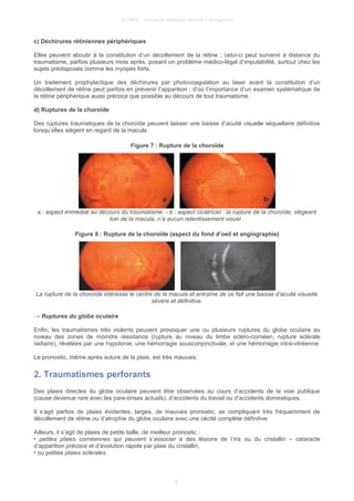 © UMVF - Université Médicale Virtuelle Francophone
c) Déchirures rétiniennes périphériques
Elles peuvent aboutir à la constitution d’un décollement de la rétine ; celui-ci peut survenir à distance du
traumatisme, parfois plusieurs mois après, posant un probléme médico-légal d’imputabilité, surtout chez les
sujets prédisposés comme les myopes forts.
Un traitement prophylactique des déchirures par photocoagulation au laser avant la constitution d’un
décollement de rétine peut parfois en prévenir l’apparition : d’où l’importance d’un examen systématique de
la rétine périphérique aussi précoce que possible au décours de tout traumatisme.
d) Ruptures de la choroïde
Des ruptures traumatiques de la choroïde peuvent laisser une baisse d’acuité visuelle séquellaire définitive
lorsqu’elles siègent en regard de la macula.
Figure 7 : Rupture de la choroïde
a : aspect immédiat au décours du traumatisme. - b : aspect cicatriciel : la rupture de la choroïde, siégeant
loin de la macula, n’a aucun retentissement visuel .
Figure 8 : Rupture de la choroïde (aspect du fond d’oeil et angiographie)
La rupture de la choroïde intéresse le centre de la macula et entraîne de ce fait une baisse d’acuité visuelle
sévère et définitive.
→ Ruptures du globe oculaire
Enfin, les traumatismes très violents peuvent provoquer une ou plusieurs ruptures du globe oculaire au
niveau des zones de moindre résistance (rupture au niveau du limbe scléro-cornéen, rupture sclérale
radiaire), révélées par une hypotonie, une hémorragie sousconjonctivale, et une hémorragie intra-vitréenne.
Le pronostic, même après suture de la plaie, est très mauvais.
2. Traumatismes perforants
Des plaies directes du globe oculaire peuvent être observées au cours d’accidents de la voie publique
(cause devenue rare avec les pare-brises actuels), d’accidents du travail ou d’accidents domestiques.
Il s’agit parfois de plaies évidentes, larges, de mauvais pronostic, se compliquant très fréquemment de
décollement de rétine ou d’atrophie du globe oculaire avec une cécité complète définitive.
Ailleurs, il s’agit de plaies de petite taille, de meilleur pronostic :
• petites plaies cornéennes qui peuvent s’associer à des lésions de l’iris ou du cristallin – cataracte
d’apparition précoce et d’évolution rapide par plaie du cristallin,
• ou petites plaies sclérales.
6
 