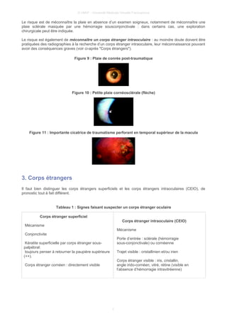 © UMVF - Université Médicale Virtuelle Francophone
Le risque est de méconnaître la plaie en absence d’un examen soigneux, notamment de méconnaître une
plaie sclérale masquée par une hémorragie sousconjonctivale : dans certains cas, une exploration
chirurgicale peut être indiquée.
Le risque est également de méconnaître un corps étranger intraoculaire : au moindre doute doivent être
pratiquées des radiographies à la recherche d’un corps étranger intraoculaire, leur méconnaissance pouvant
avoir des conséquences graves (voir ci-après "Corps étrangers").
Figure 9 : Plaie de conrée post-traumatique
Figure 10 : Petite plaie cornéosclérale (flèche)
Figure 11 : Importante cicatrice de traumatisme perforant en temporal supérieur de la macula
3. Corps étrangers
Il faut bien distinguer les corps étrangers superficiels et les corps étrangers intraoculaires (CEIO), de
pronostic tout à fait différent.
Tableau 1 : Signes faisant suspecter un corps étranger oculaire
Corps étranger superficiel
Mécanisme
Conjonctivite
Kératite superficielle par corps étranger sous-
palpébral:
toujours penser à retourner la paupière supérieure
(++).
Corps étranger cornéen : directement visible
Corps étranger intraoculaire (CEIO)
Mécanisme
Porte d’entrée : sclérale (hémorragie
sous-conjonctivale) ou cornéenne
Trajet visible : cristallinien et/ou irien
Corps étranger visible : iris, cristallin,
angle irido-cornéen, vitré, rétine (visible en
l’absence d’hémorragie intravitréenne)
7
 