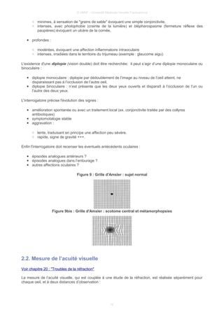 © UMVF - Université Médicale Virtuelle Francophone
○ minimes, à sensation de "grains de sable" évoquant une simple conjonctivite,
○ intenses, avec photophobie (crainte de la lumière) et blépharospasme (fermeture réflexe des
paupières) évoquant un ulcère de la cornée,
● profondes :
○ modérées, évoquant une affection inflammatoire intraoculaire
○ intenses, irradiées dans le territoire du trijumeau (exemple : glaucome aigu).
L'existence d'une diplopie (vision double) doit être recherchée; il peut s’agir d’une diplopie monoculaire ou
binoculaire :
● diplopie monoculaire : diplopie par dédoublement de l’image au niveau de l’oeil atteint, ne
disparaissant pas à l’occlusion de l’autre oeil,
● diplopie binoculaire : n’est présente que les deux yeux ouverts et disparaît à l’occlusion de l’un ou
l’autre des deux yeux.
L'interrogatoire précise l'évolution des signes :
● amélioration spontanée ou avec un traitement local (ex. conjonctivite traitée par des collyres
antibiotiques)
● symptomotalogie stable
● aggravation :
○ lente, traduisant en principe une affection peu sévère,
○ rapide, signe de gravité +++.
Enfin l'interrogatoire doit recenser les éventuels antécédents oculaires :
● épisodes analogues antérieurs ?
● épisodes analogues dans l’entourage ?
● autres affections oculaires ?
Figure 9 : Grille d'Amsler : sujet normal
Figure 9bis : Grille d'Amsler : scotome central et métamorphopsies
2.2. Mesure de l’acuité visuelle
Voir chapitre 20 : "Troubles de la réfraction"
La mesure de l’acuité visuelle, qui est couplée à une étude de la réfraction, est réalisée séparément pour
chaque oeil, et à deux distances d’observation :
10
 