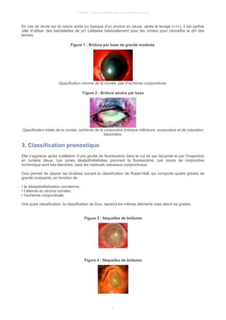 © UMVF - Université Médicale Virtuelle Francophone
En cas de doute sur la nature acide ou basique d’un produit en cause, après le lavage (+++), il est parfois
utile d’utiliser des bandelettes de pH (utilisées habituellement pour les urines) pour connaître le pH des
larmes.
Figure 1 : Brûlure par base de gravité modérée
Opacification minime de la cornée, pas d’ischémie conjonctivale.
Figure 2 : Brûlure sévère par base
Opacification totale de la cornée, ischémie de la conjonctive limbique inférieure, avasculaire et de coloration
blanchâtre.
3. Classification pronostique
Elle s’apprécie après instillation d’une goutte de fluorescéine dans le cul de sac lacrymal et par l’inspection
en lumière bleue. Les zones désépithélialisées prennent la fluorescéine. Les zones de conjonctive
ischémique sont très blanches, sans les habituels vaisseaux conjonctivaux.
Ceci permet de classer les brulûres suivant la classification de Roper-Hall, qui comporte quatre grades de
gravité croissante, en fonction de :
• la désépithélialisation cornéenne,
• l’atteinte du stroma cornéen,
• l’ischémie conjonctivale.
Une autre classification, la classification de Dua, reprend les mêmes éléments mais décrit six grades.
Figure 3 : Séquelles de brûlures
Figure 4 : Séquelles de brûlures
4
 