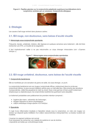 © UMVF - Université Médicale Virtuelle Francophone
Figure 6 : Papilles géantes sur la conjonctivite palpébrale supérieure (surrélévations de la
conjonctive centrées par un vaisseau). Conjonctivite allergique
2. Etiologie
Les causes d’œil rouge rentrent dans plusieurs cadres :
2.1. Œil rouge, non douloureux, sans baisse d’acuité visuelle
1. Hémorragie sous-conjonctivale spontanée
Fréquente, banale, unilatérale, indolore, elle régresse en quelques semaines sans traitement ; elle doit faire
rechercher une HTA, un trouble de la coagulation.
Il faut impérativement veiller à ne pas méconnaître un corps étranger intraoculaire (voir « Examen
clinique »).
Figure 7 : Hémorragies sous-conjonctivales spontanées
2.2. Œil rouge unilatéral, douloureux, sans baisse de l’acuité visuelle
1. Conjonctivite bactérienne
Elle se manifeste par une sensation de grains de sable, de corps étranger, un prurit.
La conjonctivite bactérienne est une rougeur conjonctivale diffuse, prédominant dans le cul-de-sac
conjonctival inférieur, le plus souvent bilatéral, parfois avec un intervalle libre. Elle entraîne des sécrétions
mucopurulentes, collant les paupières le matin au réveil. Dues à des germes à Gram positif (notamment
streptocoque ou staphylocoque), les conjonctivites bactériennes guérissent sans séquelles.
Le traitement probabiliste sans prélèvement de première intention comprend :
● hygiène des mains : prévention de l’entourage ;
● lavages fréquents au sérum physiologique ;
● collyre antibiotique à large spectre 4 à 6 fois/jour.
2. Épisclérite
Il s’agit d’une inflammation localisée à l’épisclère (située sous la conjonctive), on note une rougeur en
secteur qui disparaît après instillation d’un collyre vasoconstricteur (néosynéphrine). La douleur oculaire est
modérée.
L’examen du segment antérieur est normal.
Il est nécessaire de rechercher une maladie de système en cas de récidive.
L’épisclérite est traitée par corticothérapie locale.
6
 