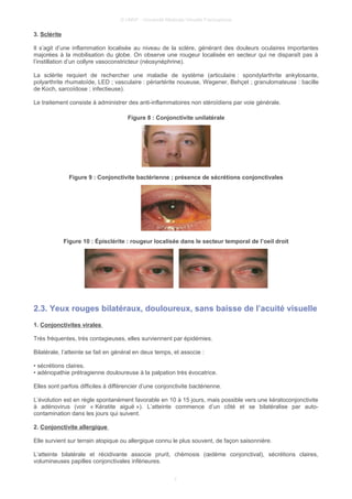 © UMVF - Université Médicale Virtuelle Francophone
3. Sclérite
Il s’agit d’une inflammation localisée au niveau de la sclère, générant des douleurs oculaires importantes
majorées à la mobilisation du globe. On observe une rougeur localisée en secteur qui ne disparaît pas à
l’instillation d’un collyre vasoconstricteur (néosynéphrine).
La sclérite requiert de rechercher une maladie de système (articulaire : spondylarthrite ankylosante,
polyarthrite rhumatoïde, LED ; vasculaire : périartérite noueuse, Wegener, Behçet ; granulomateuse : bacille
de Koch, sarcoïdose ; infectieuse).
Le traitement consiste à administrer des anti-inflammatoires non stéroïdiens par voie générale.
Figure 8 : Conjonctivite unilatérale
Figure 9 : Conjonctivite bactérienne ; présence de sécrétions conjonctivales
Figure 10 : Épisclérite : rougeur localisée dans le secteur temporal de l’oeil droit
2.3. Yeux rouges bilatéraux, douloureux, sans baisse de l’acuité visuelle
1. Conjonctivites virales
Très fréquentes, très contagieuses, elles surviennent par épidémies.
Bilatérale, l’atteinte se fait en général en deux temps, et associe :
• sécrétions claires.
• adénopathie prétragienne douloureuse à la palpation très évocatrice.
Elles sont parfois difficiles à différencier d’une conjonctivite bactérienne.
L’évolution est en règle spontanément favorable en 10 à 15 jours, mais possible vers une kératoconjonctivite
à adénovirus (voir « Kératite aiguë »). L’atteinte commence d’un côté et se bilatéralise par auto-
contamination dans les jours qui suivent.
2. Conjonctivite allergique
Elle survient sur terrain atopique ou allergique connu le plus souvent, de façon saisonnière.
L’atteinte bilatérale et récidivante associe prurit, chémosis (œdème conjonctival), sécrétions claires,
volumineuses papilles conjonctivales inférieures.
7
 