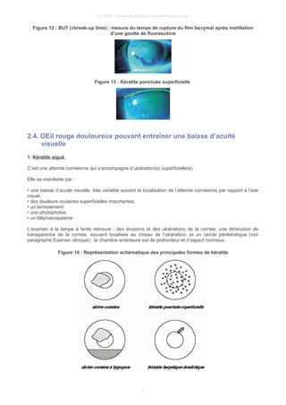 © UMVF - Université Médicale Virtuelle Francophone
Figure 12 : BUT («break-up time) : mesure du temps de rupture du film lacrymal après instillation
d’une goutte de fluorescéine
Figure 13 : Kératite ponctuée superficielle
2.4. OEil rouge douloureux pouvant entraîner une baisse d’acuité
visuelle
1. Kératite aiguë
C’est une atteinte cornéenne qui s’accompagne d’ulcération(s) superficielle(s).
Elle se manifeste par :
• une baisse d’acuité visuelle, très variable suivant la localisation de l’atteinte cornéenne par rapport à l’axe
visuel,
• des douleurs oculaires superficielles importantes,
• un larmoiement
• une photophobie
• un blépharospasme
L’examen à la lampe à fente retrouve : des érosions et des ulcérations de la cornée, une diminution de
transparence de la cornée, souvent localisée au niveau de l’ulcération, et un cercle périkératique (voir
paragraphe Examen clinique) ; la chambre antérieure est de profondeur et d’aspect normaux.
Figure 14 : Représentation schématique des principales formes de kératite
9
 