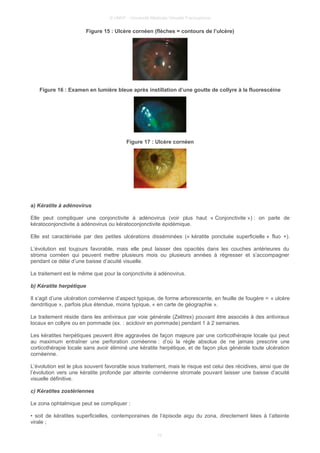 © UMVF - Université Médicale Virtuelle Francophone
Figure 15 : Ulcère cornéen (flèches = contours de l’ulcère)
Figure 16 : Examen en lumière bleue après instillation d’une goutte de collyre à la fluorescéine
Figure 17 : Ulcère cornéen
a) Kératite à adénovirus
Elle peut compliquer une conjonctivite à adénovirus (voir plus haut « Conjonctivite ») : on parle de
kératoconjonctivite à adénovirus ou kératoconjonctivite épidémique.
Elle est caractérisée par des petites ulcérations disséminées (« kératite ponctuée superficielle » fluo +).
L’évolution est toujours favorable, mais elle peut laisser des opacités dans les couches antérieures du
stroma cornéen qui peuvent mettre plusieurs mois ou plusieurs années à régresser et s’accompagner
pendant ce délai d’une baisse d’acuité visuelle.
Le traitement est le même que pour la conjonctivite à adénovirus.
b) Kératite herpétique
Il s’agit d’une ulcération cornéenne d’aspect typique, de forme arborescente, en feuille de fougère = « ulcère
dendritique », parfois plus étendue, moins typique, « en carte de géographie ».
Le traitement réside dans les antiviraux par voie générale (Zelitrex) pouvant être associés à des antiviraux
locaux en collyre ou en pommade (ex. : aciclovir en pommade) pendant 1 à 2 semaines.
Les kératites herpétiques peuvent être aggravées de façon majeure par une corticothérapie locale qui peut
au maximum entraîner une perforation cornéenne : d’où la règle absolue de ne jamais prescrire une
corticothérapie locale sans avoir éliminé une kératite herpétique, et de façon plus générale toute ulcération
cornéenne.
L’évolution est le plus souvent favorable sous traitement, mais le risque est celui des récidives, ainsi que de
l’évolution vers une kératite profonde par atteinte cornéenne stromale pouvant laisser une baisse d’acuité
visuelle définitive.
c) Kératites zostériennes
Le zona ophtalmique peut se compliquer :
• soit de kératites superficielles, contemporaines de l’épisode aigu du zona, directement liées à l’atteinte
virale ;
10
 