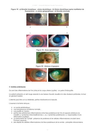 © UMVF - Université Médicale Virtuelle Francophone
Figure 18 : a) Kératite herpétique : ulcère dendritique - b) Ulcère dendritique après instillation de
fluorescéine - c) ulcère géographique - d) Kératite stromale.
Figure 19 : Zona ophtalmique
Figure 20 : Ulcères à hypopion
2. Uvéites antérieures
Ce sont des inflammations de l’iris (iritis) et du corps ciliaire (cyclite) : on parle d’iridocyclite.
Le patient présente un œil rouge associé à une baisse d’acuité visuelle et à des douleurs profondes, le tout
en général modéré.
L’atteinte peut être uni ou bilatérale, parfois récidivante et à bascule.
L’examen à la fente retrouve :
● un cercle périkératique ;
● une transparence cornéenne normale ;
● une pupille en myosis ;
● parfois des adhérences inflammatoires entre face postérieure de l’iris et capsule antérieure du
cristallin (« synéchies iridocristalliniennes », ou « synéchies postérieures »), responsables d’une
déformation pupillaire ;
● un phénomène de Tyndall : présence de protéines et de cellules inflammatoires circulant dans
l’humeur aqueuse ;
● des dépôts de cellules inflammatoires à la face postérieure de la cornée : précipités rétrocornéens.
12
 