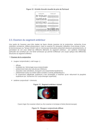 © UMVF - Université Médicale Virtuelle Francophone
Figure 12 : Echelle d'acuité visuelle de près de Parinaud
2.3. Examen du segment antérieur
Une partie de l’examen peut être réalisé de façon directe (examen de la conjonctive, recherche d’une
ulcération cornéenne, réflexe photomoteur), mais un examen fin nécessite l’utilisation d’une lampe à fente :
le biomicroscope (ou "lampe à fente") est un microscope binoculaire présentant plusieurs grossissements, et
permettant de voir avec détail les différents éléments du segment antérieur ; son système d’éclairage
particulier est constitué par une fente lumineuse qui permet d’effectuer une coupe optique des différentes
structures du segment antérieur.
1. Examen de la conjonctive
● rougeur conjonctivale (« oeil rouge ») :
○ diffuse,
○ localisée (ex. hémorragie sous-conjonctivale)
○ prédominant dans les culs-de-sac inférieurs
○ associée à des sécrétions, évoquant une conjonctivite bactérienne.
○ prédominant autour du limbe scléro-cornéen («cercle périkératique»).
○ la conjonctive palpébrale supérieure n’est accessible à l’examen qu’en retournant la paupière
supérieure (ex. recherche d'un corps étranger superficiel).
● oedème conjonctival = chemosis.
Figure 13 : Segment antérieur normal
Il peut s'agir d'un examen direct ou d'un examen à la lampe à fente (biomicroscope).
Figure 14 : Rougeur conjonctivale diffuse
12
 