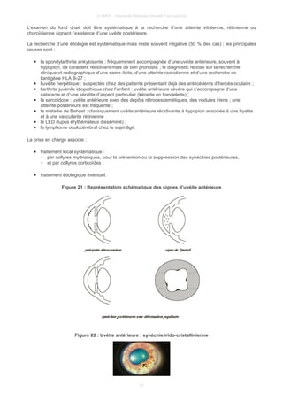 © UMVF - Université Médicale Virtuelle Francophone
L’examen du fond d’œil doit être systématique à la recherche d’une atteinte vitréenne, rétinienne ou
choroïdienne signant l’existence d’une uvéite postérieure.
La recherche d’une étiologie est systématique mais reste souvent négative (50 % des cas) ; les principales
causes sont :
● la spondylarthrite ankylosante : fréquemment accompagnée d’une uvéite antérieure, souvent à
hypopion, de caractère récidivant mais de bon pronostic ; le diagnostic repose sur la recherche
clinique et radiographique d’une sacro-iléite, d’une atteinte rachidienne et d’une recherche de
l’antigène HLA B-27 ;
● l’uvéite herpétique : suspectée chez des patients présentant déjà des antécédents d’herpès oculaire ;
● l’arthrite juvénile idiopathique chez l’enfant : uvéite antérieure sévère qui s’accompagne d’une
cataracte et d’une kératite d’aspect particulier (kératite en bandelette) ;
● la sarcoïdose : uvéite antérieure avec des dépôts rétrodescemétiques, des nodules iriens ; une
atteinte postérieure est fréquente ;
● la maladie de Behçet : classiquement uvéite antérieure récidivante à hypopion associée à une hyalite
et à une vascularite rétinienne
● le LED (lupus érythémateux disséminé) ;
● le lymphome oculocérébral chez le sujet âgé.
La prise en charge associe :
● traitement local systématique :
○ par collyres mydriatiques, pour la prévention ou la suppression des synéchies postérieures,
○ et par collyres corticoïdes ;
● traitement étiologique éventuel.
Figure 21 : Représentation schématique des signes d’uvéite antérieure
Figure 22 : Uvéite antérieure : synéchie irido-cristallinienne
13
 
