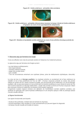 © UMVF - Université Médicale Virtuelle Francophone
Figure 23 : Uvéite antérieure : précipités rétro-cornéens
Figure 24 : Uvéite antérieure : précipités rétrocornéens (examen la lampe à fente) et Uvéite antérieure
à hypopion au cours d’une spondylarthrite ankylosante.
Figure 25 : Kératite en bandelette (uvéite antérieure au cours d’une arthrite chronique juvénile de
l’enfant)
3. Glaucome aigu par fermeture de l’angle
C’est une affection rare mais de pronostic sévère en l’absence d’un traitement précoce.
Le glaucome aigu par fermeture de l'angle survient :
• sur des facteurs prédisposants :
- forte hypermétropie,
- chambre antérieure étroite,
- angle irido-cornéen étroit,
- gros cristallin
• lors de circonstances entraînant une mydriase (stress, prise de médicaments mydriatiques, obscurité).
La crise est due à un blocage pupillaire. La mydriase entraîne un accolement de la face antérieure du
cristallin et de la face postérieure de l’iris sur 360°. L’humeur acqueuse produite au niveau des procès
ciliaires en arrière de l’iris, passe à travers la pupille, puis est évacuée par le trabéculum. En cas de blocage
pupillaire, elle ne peut plus passer et s’accumule dans la chambre postérieure ce qui refoule la racine de l’iris
vers l’avant et aboutit à un blocage trabéculaire. L’angle irido-cornéen se ferme et l’humeur acqueuse n’étant
plus évacuée à travers le trabéculum la pression intra-oculaire augmente.
L’hypertonie oculaire majeure entraine une altération de l’endothélium cornéen (oedème cornéen), une
ischémie du sphincter irien (semi-mydriase aréflectique) et une atrophie optique si elle se prolonge (baisse
d’acuité visuelle définite).
a) Signes fonctionnels
Les signes fonctionnels sont bryants :
• douleurs très profondes, irradiant dans le territoire du trijumeau
• souvent associées à des nausées ou à des vomissements qui peuvent égarer le diagnostic
• la baisse d’acuité visuelle est brutale et massive
14
 