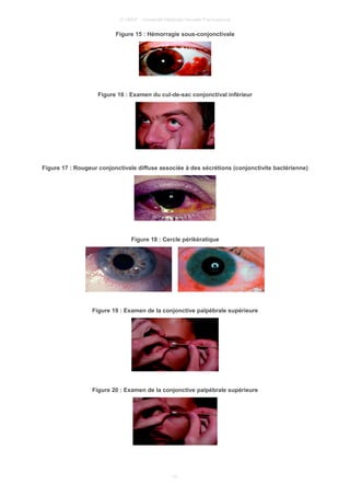 © UMVF - Université Médicale Virtuelle Francophone
Figure 15 : Hémorragie sous-conjonctivale
Figure 16 : Examen du cul-de-sac conjonctival inférieur
Figure 17 : Rougeur conjonctivale diffuse associée à des sécrétions (conjonctivite bactérienne)
Figure 18 : Cercle périkératique
Figure 19 : Examen de la conjonctive palpébrale supérieure
Figure 20 : Examen de la conjonctive palpébrale supérieure
13
 