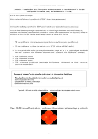 © UMVF - Université Médicale Virtuelle Francophone
Tableau 1 : Classification de la rétinopathie diabétique (selon la classification de la Société
francophone du diabète (SFD), anciennement ALFEDIAM)
Pas de rétinopathie diabétique
Rétinopathie diabétique non proliférante (RDNP, absence de néovaisseaux)
Rétinopathie diabétique proliférante (RDP ; selon la taille et la localisation des néovaisseaux) :
Chaque stade de rétinopathie peut être associé à un certain degré d'oedème maculaire diabétique ;
l"oedème maculaire est classifié minime, modéré ou sévère, selon sa localisation par rapport au centre de
la macula. Il est considéré comme sévère lorsqu'il atteint le centre de la macula.
● RD non proliférante minime (quelques microanévrismes ou hémorragies punctiformes).
● RD non proliférante modérée (par exclusion si ni RDNP minime ni RDNP sévère)
● RD non proliférante sévère (ou RD préproliférante) : règle du "4, 2, 1" (hémorragies rétiniennes
dans les 4 quadrants et/ou dilatations veineuses dans 2 quadrants et/ou AMIR dans 1 quadrant)
● RDP proliférante minime
● RDP proliférante modérée
● RDP proliférante sévère
● RDP proliférante compliquée (hémorragie intravitréenne, décollement de rétine tractionnel,
glaucome néovasculaire)
Causes de baisse d'acuité visuelle sévère due à la rétinopathie diabétique
- Maculopathie diabétique (oedème maculaire, exsudats lipidiques)
- Hémorragie intravitréenne
- Décollement de rétine par traction
- Glaucome néovasculaire
Figure 9 : RD non proliférante modérée : hémorragie en taches peu nombreuses
Figure 10 : RD non proliférante sévère : nombreuses hémorragies en taches sur toute la périphérie
9
 