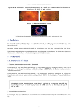 © UMVF - Université Médicale Virtuelle Francophone
Figure 11 : A. Prolifération fibrovasculaire (flèches) - B. Celle-ci peut par sa contraction entraîner un
décollement de rétine dit «par traction»
Figure 12 : Néovascularisation irienne
Présence de néovaisseaux, normalement absents, sur la face antérieure de l’iris.
4. Evolution
L’évolution de la rétinopathe diabétique est habituellement lente, et se fait progressivement tout au long de la
vie du diabétique.
La baisse visuelle liée à l’oedème maculaire est progressive, mais peut à la longue entraîner une cécité.
Une hémorragie intra-vitréenne par saignement des néovaisseaux, un décollement de rétine ou un glaucome
néovasculaire entraînent une perte brutale et quasi-complète de la vision.
5. Traitement
5.1. Traitement médical
1. Équilibre glycémique et tensionnel - primordial
L’effet bénéfique chez les diabétiques de type 1 d’une bonne équilibration glycémique sur l’incidence et la
progression de la rétinopathie diabétique a été démontré par le DCCT (Diabetic Control and Complications
Trial Research Group).
L’effet bénéfique chez les diabétiques de type 2 d’un bon équilibre glycémique mais aussi du contrôle de
l’hypertension artérielle est également démontré par l’étude UKPDS (United Kingdom Prospective Diabetes
Study).
Le meilleur contrôle possible de ces deux facteurs (glycémie et hypertension artérielle) est
important pour réduire et ralentir la progression de la RD tant chez les diabétiques de type 1
que de type 2.
2.Traitements médicamenteux
Il n'existe pas à ce jour de traitement médicamenteux susceptible d'améliorer ou de ralentir l'évolution de la
RD.
10
 