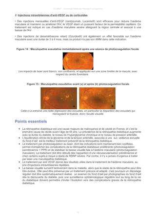 © UMVF - Université Médicale Virtuelle Francophone
2. Injections intravitréennes d'anti-VEGF ou de corticoïdes
• Des injections mensuelles d'anti-VEGF (ranibizumab, Lucentis®) sont efficaces pour réduire l'oedème
maculaire et maintenir ou amélorer l'AV, le VEGF étant un puissant facteur de la perméabilité capillaire. Ce
traitement est indiqué en cas d'oedème maculaire sévère atteignant la région centrale et associé à une
baisse de l'AV.
• Des injections de dexaméthasone retard (Ozurdex®) ont également un effet favorable sur l'oedème
maculaire avec une durée de 3 à 4 mois, mais ce produit n'a pas son AMM dans cette indication.
Figure 14 : Maculopathie exsudative immédiatement après une séance de photocoagulation focale
Les impacts de laser sont blancs, non confluents, et appliqués sur une zone limitée de la macula, avec
respect du centre fovéolaire.
Figure 15 : Maculopathie exsudative avant (a) et après (b) photocoagulation focale
Celle-ci a entraîné une nette régression des exsudats, en particulier la disparition des exsudats qui
menaçaient la fovéola, donc l’acuité visuelle
Points essentiels
● La rétinopathie diabétique est une cause majeure de malvoyance et de cécité en France, et c’est la
première cause de cécité avant l’âge de 55 ans. La prévalence de la rétinopathie diabétique augmente
avec la durée du diabète, le niveau de l’hyperglycémie chronique et le niveau de pression artérielle.
● L’équilibration stricte de la glycémie et de la tension artérielle, associée à une sur- veillance annuelle
du fond d’œil est le meilleur traitement préventif de la rétinopathie diabétique.
● Le traitement par photocoagulation au laser, dont les indications sont maintenant bien codiﬁées,
permet d’empêcher les complications de la rétinopathie diabétique proliférante (photocoagulation
panrétinienne = PPR) et de stabiliser la baisse visuelle liée à l’œdème maculaire (photocoagulation
maculaire). Le traitement doit être débuté dès l’apparition d’une néovascularisation prérétinienne et
chez certains sujets à risque a stade de RDNP sévère. Par contre, il n’y a jamais d’urgence à traiter
par laser une maculopathie diabétique.
● Le traitement par anti VEGF donne des résultats utiles dans le traitement de l'œdème maculaire, au
prix d'injections intravitréeenes répétées.
● La baisse visuelle survient tardivement dans la maladie, alors que le stade de la rétinopathie peut être
très évolué,. Elle peut être prévenue par un traitement précoce et adapté, c'est pourquoi un dépistage
régulier doit être systématiquement réalisé: un examen du fond d’œil par photographies du fond d’œil
dès la découverte du diabète, puis une surveillance ophtalmologique régulière tout au long de la vie
du diabétique doivent permettre d’éviter l’évolution vers des complications graves de la rétinopathie
diabétique.
12
 