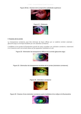 © UMVF - Université Médicale Virtuelle Francophone
Figure 20 bis : Examen de la conjonctive palpébrale supérieure
Figure 21 : Chémosis
2. Examen de la cornée
La transparence cornéenne peut être diminuée de façon diffuse par un oedème cornéen (exemple :
glaucome aigu) ou de façon localisée par une ulcération cornéenne;
L’instillation d’une goutte de fluoréscéine permet de mieux visualiser une ulcération cornéenne, notamment
si on l’examine avec une lumière bleue qui fait apparaître l’ulcération en vert.
Figure 22 : Diminution de transparence diffuse de la cornée (glaucome aigu)
Figure 23 : Diminution de transparence localisée de la cornée (ulcération cornéenne)
Figure 24 : Ulcération cornéenne
Figure 25 : Examen d'une ulcération cornéenne après instillation d'un collyre à la fluorescéine
14
 
