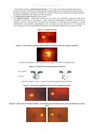 © UMVF - Université Médicale Virtuelle Francophon
: «Sémiologie oculaire») généralement élevée (> 21 mm Hg), mais parfois normale (glaucome à
pression normale). Il est souvent nécessaire de réaliser également une pachymétrie cornéenne afin
de mesurer l’épaisseur cornéenne. En effet, les cornées minces ou au contraire les cornées épaisses
modifient artificiellement les chiffres de PIO à l’examen.
● un angle irido-cornéen ouvert en gonioscopie,
● une papille excavée , c’est-à-dire creusée en son centre par raréfaction progressive des fibres
nerveuses qui forment le nerf optique : cette excavation pathologique s’apprécie en mesurant le
«rapport cup-disc» (rapport entre la surface de l’excavation et la surface de la papille) ; il existe
normalement une excavation physiologique avec un rapport cup-disc d’environ 0,3 : on observe au
cours du glaucome une augmentation progressive de l’excavation papillaire et du rapport cup-disc.
Figure 2 : Papille normale
Figure 3 : Excavation papillaire glaucomateuse (augmentation du rapport cup/disc)
Il existe une dépression (cup) excessive par rapport à la taille de la papille (disc).
Figure 4 : Évolution de la papille glaucomateuse
A gauche: aspect normal, - à droite: excavation papillaire glaucomateuse.
Figure 5 : Excavation papillaire et Excavation papillaire évoluée
Figure 6 : Glaucome chronique bilatéral : excavation glaucomateuse à peu prés symétrique aux deux
yeux
6
 