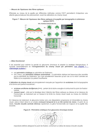 © UMVF - Université Médicale Virtuelle Francophon
→ Mesure de l’épaisseur des fibres optiques
Effectuée au niveau de la papille par différentes méthodes comme l’OCT permetternt d’objectiver une
atteinte glaucomateuse très précocement, avant les altérations du champ visuel.
Figure 7 : Mesure de l’épaisseur des fibres optiques à la papille par tomographie à cohérence
optique (OCT)
→ Bilan fonctionnel
Il est essentiel pour estimer la gravité du glaucome chronique et adapter la stratégie thérapeutique. Il
consiste essentiellement en l’enregistrement du champ visuel par périmétrie (voir chapitre 1 :
«Sémiologie oculaire») :
● soit périmétrie cinétique au périmètre de Goldmann,
● soit, mieux, par périmétrie statique automatisée . La périmétrie statique est beaucoup plus sensible
que la périmétrie de Goldmann, qui n’est actuellement réservée qu’aux cas où la vision centrale est
faible ou la coopération du patient insuffisante.
L’altération du champ visuel est principalement marquée par l’apparition de scotomes dont la topographie
et la forme sont parfois évocatrices :
● scotome arciforme de Bjerrum (+++) , partant de la tache aveugle et contournant le point de fixation
central,
● ressaut nasal , créé par le décalage dans l’atteinte des fibres optiques au dessus et en dessous de
l’horizontale, se traduisant par un ressaut à la limite du champ visuel nasal, au niveau du méridien
horizontal.
En l’absence de traitement, le glaucome évolue vers une dégradation progressive et irréversible du champ
visuel, celui-ci étant réduit à un simple croissant temporal et à un ilôt central de vision. À partir de ce
stade, l’acuité visuelle centrale diminue rapidement, la gêne fonctionnelle est majeure et la papille très
excavée.
Figure 8 : Périmétrie cinétique d’un glaucome chronique évolué
Importants déficits atteignant le point de fixation, entraînant un début de baisse d’acuité visuelle.
7
 