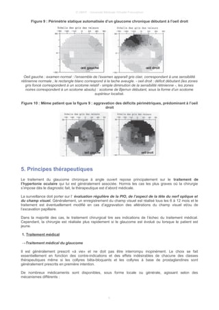 © UMVF - Université Médicale Virtuelle Francophon
Figure 9 : Périmétrie statique automatisée d’un glaucome chronique débutant à l’oeil droit
Oeil gauche : examen normal : l’ensemble de l’examen apparaît gris clair, correspondant à une sensibilité
rétinienne normale ; le rectangle blanc correspond à la tache aveugle. - oeil droit : déficit débutant (les zones
gris foncé correspondent à un scotome relatif - simple diminution de la sensibilité rétinienne -, les zones
noires correspondent à un scotome absolu) : scotome de Bjerrun débutant, sous la forme d’un scotome
supérieur localisé.
Figure 10 : Même patient que la figure 9 : aggravation des déficits périmétriques, prédominant à l’oeil
droit
5. Principes thérapeutiques
Le traitement du glaucome chronique à angle ouvert repose principalement sur le traitement de
l’hypertonie oculaire qui lui est généralement associée. Hormis les cas les plus graves où la chirurgie
s’impose dès le diagnostic fait, la thérapeutique est d’abord médicale.
La surveillance doit porter sur l’ évaluation régulière de la PIO, de l’aspect de la tête du nerf optique et
du champ visuel. Généralement, un enregistrement du champ visuel est réalisé tous les 6 à 12 mois et le
traitement est éventuellement modifié en cas d’aggravation des altérations du champ visuel et/ou de
l’excavation papillaire.
Dans la majorité des cas, le traitement chirurgical tire ses indications de l’échec du traitement médical.
Cependant, la chirurgie est réalisée plus rapidement si le glaucome est évolué ou lorsque le patient est
jeune.
1. Traitement médical
→Traitement médical du glaucome
Il est généralement prescrit «à vie» et ne doit pas être interrompu inopinément. Le choix se fait
essentiellement en fonction des contre-indications et des effets indésirables de chacune des classes
thérapeutiques même si les collyres bêta-bloquants et les collyres à base de prostaglandines sont
généralement prescrits en première intention.
De nombreux médicaments sont disponibles, sous forme locale ou générale, agissant selon des
mécanismes différents :
8
 