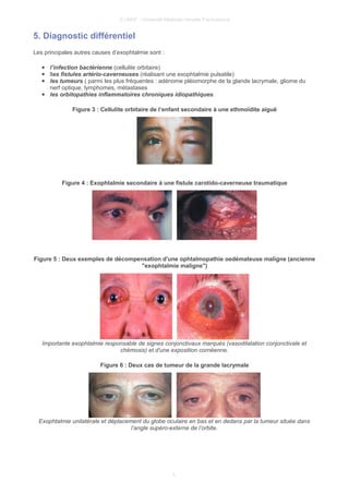 © UMVF - Université Médicale Virtuelle Francophone
5. Diagnostic différentiel
Les principales autres causes d’exophtalmie sont :
● l’infection bactérienne (cellulite orbitaire)
● lles fistules artério-caverneuses (réalisant une exophtalmie pulsatile)
● les tumeurs ( parmi les plus fréquentes : adénome pléiomorphe de la glande lacrymale, gliome du
nerf optique, lymphomes, métastases
● les orbitopathies inflammatoires chroniques idiopathiques.
Figure 3 : Cellulite orbitaire de l’enfant secondaire à une ethmoïdite aiguë
Figure 4 : Exophtalmie secondaire à une fistule carotido-caverneuse traumatique
Figure 5 : Deux exemples de décompensation d'une ophtalmopathie oedémateuse maligne (ancienne
"exophtalmie maligne")
Importante exophtalmie responsable de signes conjonctivaux marqués (vasodilatation conjonctivale et
chémosis) et d'une exposition cornéenne.
Figure 6 : Deux cas de tumeur de la grande lacrymale
Exophtalmie unilatérale et déplacement du globe oculaire en bas et en dedans par la tumeur située dans
l’angle supéro-externe de l’orbite.
5
 