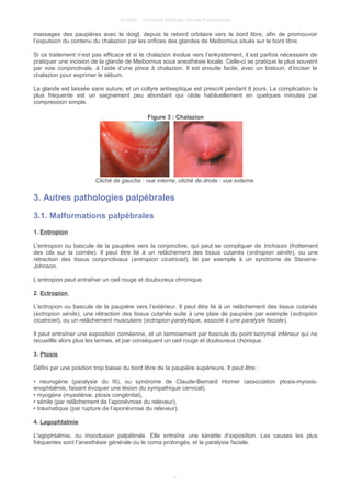 © UMVF - Université Médicale Virtuelle Francophone
massages des paupières avec le doigt, depuis le rebord orbitaire vers le bord libre, afin de promouvoir
l’expulsion du contenu du chalazion par les orifices des glandes de Meibomius situés sur le bord libre.
Si ce traitement n’est pas efficace et si le chalazion évolue vers l’enkystement, il est parfois nécessaire de
pratiquer une incision de la glande de Meibomius sous anesthésie locale. Celle-ci se pratique le plus souvent
par voie conjonctivale, à l’aide d’une pince à chalazion. Il est ensuite facile, avec un bistouri, d’inciser le
chalazion pour exprimer le sébum.
La glande est laissée sans suture, et un collyre antiseptique est prescrit pendant 8 jours. La complication la
plus fréquente est un saignement peu abondant qui cède habiluellement en quelques minutes par
compression simple.
Figure 3 : Chalazion
Cliché de gauche : vue interne, cliché de droite : vue externe.
3. Autres pathologies palpébrales
3.1. Malformations palpébrales
1. Entropion
L'entropion ou bascule de la paupière vers la conjonctive, qui peut se compliquer de trichiasis (frottement
des cils sur la cornée). Il peut être lié à un relâchement des tissus cutanés (entropion sénile), ou une
rétraction des tissus conjonctivaux (entropion cicatriciel), lié par exemple à un syndrome de Stevens-
Johnson.
L‘entropion peut entraîner un oeil rouge et douloureux chronique.
2. Ectropion
L'ectropion ou bascule de la paupière vers l’extérieur. Il peut être lié à un relâchement des tissus cutanés
(ectropion sénile), une rétraction des tissus cutanés suite à une plaie de paupière par exemple (ectropion
cicatriciel), ou un relâchement musculaire (ectropion paralytique, associé à une paralysie faciale).
Il peut entraîner une exposition cornéenne, et un larmoiement par bascule du point lacrymal inférieur qui ne
recueillle alors plus les larmes, et par conséquent un oeil rouge et douloureux chonique.
3. Ptosis
Défini par une position trop basse du bord libre de la paupière supérieure. Il peut être :
• neurogène (paralysie du III), ou syndrome de Claude-Bernard Horner (association ptosis-myosis-
enophtalmie, faisant évoquer une lésion du sympathique cervical).
• myogène (myasténie, ptosis congénital),
• sénile (par relâchement de l’aponévrose du releveur),
• traumatique (par rupture de l’aponévrose du releveur).
4. Lagophtalmie
L'agophtalmie, ou inocclusion palpébrale. Elle entraîne une kératite d’exposition. Les causes les plus
fréquentes sont l’anesthésie générale ou le coma prolongés, et la paralysie faciale.
5
 