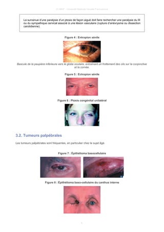 © UMVF - Université Médicale Virtuelle Francophone
La survenue d’une paralysie d’un ptosis de façon aiguë doit faire rechercher une paralysie du III
ou du sympathique cervical associé à une lésion vasculaire (rupture d’anévrysme ou dissection
carotidienne).
Figure 4 : Entropion sénile
Bascule de la paupière inférieure vers le globe oculaire, entraînant un frottement des cils sur la conjonctive
et la cornée.
Figure 5 : Ectropion sénile
Figure 6 : Ptosis congénital unilatéral
3.2. Tumeurs palpébrales
Les tumeurs palpébrales sont fréquentes, en particulier chez le sujet âgé.
Figure 7 : Épithélioma basocellulaire
Figure 8 : Épithélioma baso-cellulaire du canthus interne
6
 