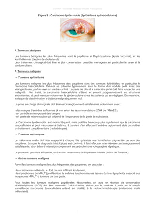 © UMVF - Université Médicale Virtuelle Francophone
Figure 9 : Carcinome épidermoïde (épithélioma spino-cellulaire)
1. Tumeurs bénignes
Les tumeurs bénignes les plus fréquentes sont le papillome et l’hydrocystome (kyste lacrymal), et les
Xanthélesmas (dépôts de cholestérol)
Leur traitement chirurgical doit être le plus conservateur possible, ménageant en particulier le tarse et la
bordure ciliaire.
2. Tumeurs malignes
→ Tumeurs épithéliales
Les tumeurs malignes les plus fréquentes des paupières sont des tumeurs épithéliales, en particulier le
carcinome basocellulaire. Celui-ci se présente typiquement sous la forme d’un nodule perlé avec des
télangiectasies, parfois avec un ulcère central. La perte de cils et le caractère perlé doit faire suspecter une
malignité. Non traité, le carcinome basocellulaire s’étend et envahi progressivement les structures
avoisinantes, et peut menacer notamment le globe oculaire chez les patients qui se négligent. En revanche,
le risque de dissémination à distance est pratiquement nul.
La prise en charge chirurgicale doit être carcinologiquement satisfaisante, notamment avec :
• des marges d’exérèse suffisantes (4 mm selon les recommandations 2004 de l’ANAES),
• un contrôle ex-temporané des berges
• un geste de reconstruction qui dépend de l’importance de la perte de substance.
Le Carcinome épidermoïde est moins fréquent, mais prolifère beaucoup plus rapidement que le carcinome
basocellulaire, et peut métastaser à distance. Il convient d’en effectuer l’exérèse rapidement et de considérer
un traitement complémentaire (radiothérapie).
→ Tumeurs mélaniques
Le mélanome malin doit être suspecté à chaque fois qu’existe une tuméfaction pigmentée ou non des
paupières. Lorsque le diagnostic histologique est confirmé, il faut effectuer une exérèse carcinologiquement
satisfaisante, et un bilan d’extension comprenant en particulier une échographie hépatique.
Le pronostic peut être effroyable, en fonction notamment de l’épaisseur initiale (indice de Brestlow).
→ Autres tumeurs malignes
Parmi les tumeurs malignes les plus fréquentes des paupières, on peut citer :
• les carcinomes sébacés, au fort pouvoir infiltrant localement,
• les lymphomes de MALT (prolifération de cellules lymphomateuses issues du tissu lymphoïde associé aux
muqueuses -MALT-), tumeurs de bas grade.
Pour toutes les tumeurs malignes palpébrales découvertes, un avis en réunion de concertation
pluridisciplinaire (RCP) doit être demandé. Celui-ci devra statuer sur la conduite à tenir, de la simple
surveillance (carcinome basocellulaire enlevé en totalité) à la radio-chimiothérapie (mélanome malin
métastasé).
7
 