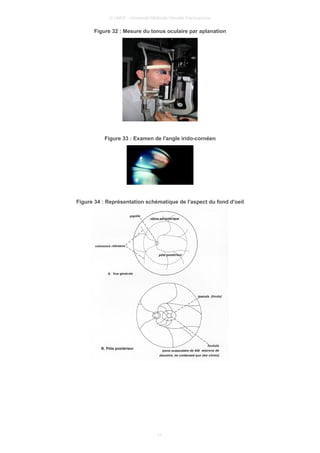 © UMVF - Université Médicale Virtuelle Francophone
Figure 32 : Mesure du tonus oculaire par aplanation
Figure 33 : Examen de l'angle irido-cornéen
Figure 34 : Représentation schématique de l'aspect du fond d'oeil
17
 