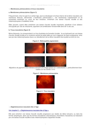 © UMVF - Université Médicale Virtuelle Francophone
→ Membranes prémaculaires et trous maculaires
a. Membranes prémaculaires (figure 3)
Fréquemment, chez le sujet d’un certain âge, peut se développer à la face interne de la rétine maculaire une
membrane fibreuse, dénommée « membrane prémaculaire » ; ces membranes s’épaississent et se
contractent lentement au cours de leur évolution, entraînant une baisse d’acuité visuelle et des
métamorphopsies d’installation lente.
Elles peuvent, quand elles entraînent une baisse d’acuité visuelle importante, bénéficier d’une ablation
chirurgicale par voie de vitrectomie, apportant une amélioration fonctionnelle dans 80 % des cas.
b. Trous maculaires (figure 4)
Moins fréquents, ils correspondent à un trou fovéolaire de formation brutale : ils se traduisent par une baisse
d’acuité visuelle brutale et un scotome central de petite taille qui vont s’aggraver de façon progressive, ainsi
que par des métamorphopsies dues à un décollement de la rétine maculaire très localisé au bord du trou.
Figure 2 : Rétinopathie pigmentaire
Migrations de pigments sous-rétiniens donnant une image typique en «ostéoblastes », particulièrement bien
visibles sur les clichés c et d.
Figure 3 : Membrane prémaculaire
Figure 4 : Trou maculaire
→ Dégénérescence maculaire liée à l’âge
Voir chapitre 5 : « Dégénérescence maculaire liée à l’âge ».
Elle peut entraîner une baisse d’acuité visuelle progressive aux stades de début (drusen), ou dans les
formes atrophiques, alors que les formes exsudatives (néovaisseaux choroïdiens maculaires) se traduisent
par une baisse d’acuité visuelle et des métamorphopsies d’apparition brutale.
6
 