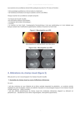 © UMVF - Université Médicale Virtuelle Francophone
Les examens de surveillance doivent être pratiqués tous les 6 à 18 mois en fonction :
• de la posologie quotidienne et de la durée du traitement ;
• de l’existence de facteurs de risque oculaires comme une DMLA.
Chaque examen de surveillance complet comporte :
• la mesure de l’acuité visuelle ;
•une périmétrie statique automatisée ;
• un examen de la vision chromatique ;
• un EOG ;
• un examen du fond d’œil ; l’angiographie fluorescéinique n’est pas systématique et n’est réalisée que
lorsque existent des modifications pigmentaires visibles à l’examen du fond d’œil.
Figure 4 : Maculopathie aux APS
Maculopathie en «oeil de boeuf» aux deux yeux.
Figure 4 bis : Maculopathie aux APS
Angiographie fluorescéinique de l’oeil droit.
4. Altérations du champ visuel (figure 5)
Elle peuvent ou non s’accompagner d’un baisse d’acuité visuelle.
1. Anomalies du champ visuel au cours d’affections rétiniennes
Ce sont :
• soit des scotomes en cas d’atteinte de la rétine centrale respectant la périphérie ; un scotome central,
englobant le point de fixation, traduit une atteinte maculaire et s’accompagne toujours d’une baisse d’acuité
visuelle sévère (ex. : DMLA évoluée) ;
• soit des déficits périphériques du champ visuel lors d’atteintes rétiniennes siégeant ou débutant en
périphérie (ex. : décollement de la rétine rhegmatogène, rétinopathie pigmentaire).
8
 