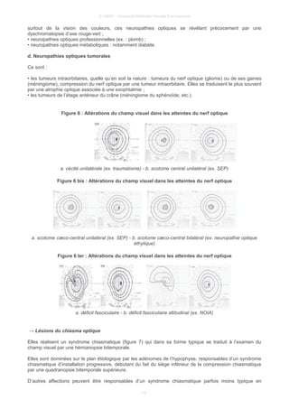 © UMVF - Université Médicale Virtuelle Francophone
surtout de la vision des couleurs, ces neuropathies optiques se révélant précocement par une
dyschromatopsie d’axe rouge-vert ;
• neuropathies optiques professionnelles (ex. : plomb) ;
• neuropathies optiques métaboliques : notamment diabète.
d. Neuropathies optiques tumorales
Ce sont :
• les tumeurs intraorbitaires, quelle qu’en soit la nature : tumeurs du nerf optique (gliome) ou de ses gaines
(méningiome), compression du nerf optique par une tumeur intraorbitaire. Elles se traduisent le plus souvent
par une atrophie optique associée à une exophtalmie ;
• les tumeurs de l’étage antérieur du crâne (méningiome du sphénoïde, etc.).
Figure 6 : Altérations du champ visuel dans les atteintes du nerf optique
a. cécité unilatérale (ex. traumatisme) - b. scotome central unilatéral (ex. SEP)
Figure 6 bis : Altérations du champ visuel dans les atteintes du nerf optique
a. scotome cæco-central unilatéral (ex. SEP) - b. scotome cæco-central bilatéral (ex. neuropathie optique
éthylique)
Figure 6 ter : Altérations du champ visuel dans les atteintes du nerf optique
a. déficit fasciculaire - b. déficit fasciculaire altitudinal (ex. NOIA)
→ Lésions du chiasma optique
Elles réalisent un syndrome chiasmatique (figure 7) qui dans sa forme typique se traduit à l’examen du
champ visuel par une hémianopsie bitemporale.
Elles sont dominées sur le plan étiologique par les adénomes de l’hypophyse, responsables d’un syndrome
chiasmatique d’installation progressive, débutant du fait du siège inférieur de la compression chiasmatique
par une quadranopsie bitemporale supérieure.
D’autres affections peuvent être responsables d’un syndrome chiasmatique parfois moins typique en
10
 