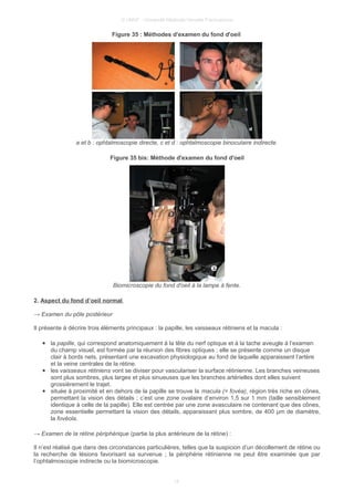 © UMVF - Université Médicale Virtuelle Francophone
Figure 35 : Méthodes d'examen du fond d'oeil
a et b : ophtalmoscopie directe, c et d : ophtalmoscopie binoculaire indirecte.
Figure 35 bis: Méthode d'examen du fond d'oeil
Biomicroscopie du fond d'oeil à la lampe à fente.
2. Aspect du fond d’oeil normal
→ Examen du pôle postérieur
Il présente à décrire trois éléments principaux : la papille, les vaisseaux rétiniens et la macula :
● la papille, qui correspond anatomiquement à la tête du nerf optique et à la tache aveugle à l’examen
du champ visuel, est formée par la réunion des fibres optiques ; elle se présente comme un disque
clair à bords nets, présentant une excavation physiologique au fond de laquelle apparaissent l’artère
et la veine centrales de la rétine.
● les vaisseaux rétiniens vont se diviser pour vasculariser la surface rétinienne. Les branches veineuses
sont plus sombres, plus larges et plus sinueuses que les branches artérielles dont elles suivent
grossièrement le trajet.
● située à proximité et en dehors de la papille se trouve la macula (= fovéa), région très riche en cônes,
permettant la vision des détails ; c’est une zone ovalaire d’environ 1,5 sur 1 mm (taille sensiblement
identique à celle de la papille). Elle est centrée par une zone avasculaire ne contenant que des cônes,
zone essentielle permettant la vision des détails, apparaissant plus sombre, de 400 μm de diamètre,
la fovéola.
→ Examen de la rétine périphérique (partie la plus antérieure de la rétine) :
Il n’est réalisé que dans des circonstances particulières, telles que la suspicion d’un décollement de rétine ou
la recherche de lésions favorisant sa survenue ; la périphérie rétinienne ne peut être examinée que par
l’ophtalmoscopie indirecte ou la biomicroscopie.
18
 