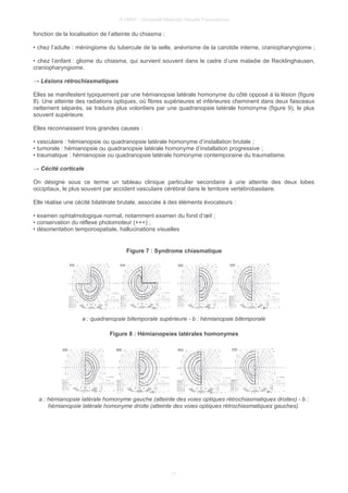 © UMVF - Université Médicale Virtuelle Francophone
fonction de la localisation de l’atteinte du chiasma :
• chez l’adulte : méningiome du tubercule de la selle, anévrisme de la carotide interne, craniopharyngiome ;
• chez l’enfant : gliome du chiasma, qui survient souvent dans le cadre d’une maladie de Recklinghausen,
craniopharyngiome.
→ Lésions rétrochiasmatiques
Elles se manifestent typiquement par une hémianopsie latérale homonyme du côté opposé à la lésion (figure
8). Une atteinte des radiations optiques, où fibres supérieures et inférieures cheminent dans deux faisceaux
nettement séparés, se traduira plus volontiers par une quadranopsie latérale homonyme (figure 9), le plus
souvent supérieure.
Elles reconnaissent trois grandes causes :
• vasculaire : hémianopsie ou quadranopsie latérale homonyme d’installation brutale ;
• tumorale : hémianopsie ou quadranopsie latérale homonyme d’installation progressive ;
• traumatique : hémianopsie ou quadranopsie latérale homonyme contemporaine du traumatisme.
→ Cécité corticale
On désigne sous ce terme un tableau clinique particulier secondaire à une atteinte des deux lobes
occipitaux, le plus souvent par accident vasculaire cérébral dans le territoire vertébrobasilaire.
Elle réalise une cécité bilatérale brutale, associée à des éléments évocateurs :
• examen ophtalmologique normal, notamment examen du fond d’œil ;
• conservation du réflexe photomoteur (+++) ;
• désorientation temporospatiale, hallucinations visuelles
Figure 7 : Syndrome chiasmatique
a : quadranopsie bitemporale supérieure - b : hémianopsie bitemporale
Figure 8 : Hémianopsies latérales homonymes
a : hémianopsie latérale homonyme gauche (atteinte des voies optiques rétrochiasmatiques droites) - b :
hémianopsie latérale homonyme droite (atteinte des voies optiques rétrochiasmatiques gauches).
11
 