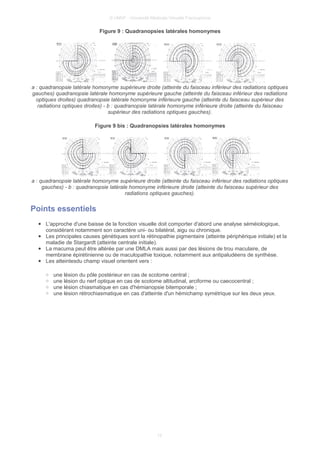 © UMVF - Université Médicale Virtuelle Francophone
Figure 9 : Quadranopsies latérales homonymes
a : quadranopsie latérale homonyme supérieure droite (atteinte du faisceau inférieur des radiations optiques
gauches) quadranopsie latérale homonyme supérieure gauche (atteinte du faisceau inférieur des radiations
optiques droites) quadranopsie latérale homonyme inférieure gauche (atteinte du faisceau supérieur des
radiations optiques droites) - b : quadranopsie latérale homonyme inférieure droite (atteinte du faisceau
supérieur des radiations optiques gauches).
Figure 9 bis : Quadranopsies latérales homonymes
a : quadranopsie latérale homonyme supérieure droite (atteinte du faisceau inférieur des radiations optiques
gauches) - b : quadranopsie latérale homonyme inférieure droite (atteinte du faisceau supérieur des
radiations optiques gauches).
Points essentiels
● L'approche d'une baisse de la fonction visuelle doit comporter d'abord une analyse séméiologique,
considérant notamment son caractère uni- ou bilatéral, aigu ou chronique.
● Les principales causes génétiques sont la rétinopathie pigmentaire (atteinte périphérique initiale) et la
maladie de Stargardt (atteinte centrale initiale).
● La macuma peut être altérée par une DMLA mais aussi par des lésions de trou maculaire, de
membrane épirétinienne ou de maculopathie toxique, notamment aux antipaludéens de synthèse.
● Les atteintesdu champ visuel orientent vers :
○ une lésion du pôle postérieur en cas de scotome central ;
○ une lésion du nerf optique en cas de scotome altitudinal, arciforme ou caecocentral ;
○ une lésion chiasmatique en cas d'hémianopsie bitemporale ;
○ une lésion rétrochiasmatique en cas d'atteinte d'un hémichamp symétrique sur les deux yeux.
12
 