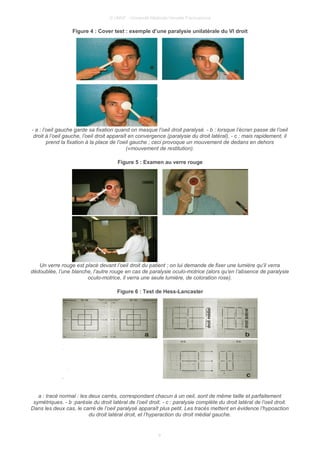 © UMVF - Université Médicale Virtuelle Francophone
Figure 4 : Cover test : exemple d’une paralysie unilatérale du VI droit
- a : l’oeil gauche garde sa fixation quand on masque l’oeil droit paralysé. - b : lorsque l’écran passe de l’oeil
droit à l’oeil gauche, l’oeil droit apparaît en convergence (paralysie du droit latéral), - c : mais rapidement, il
prend la fixation à la place de l’oeil gauche ; ceci provoque un mouvement de dedans en dehors
(«mouvement de restitution).
Figure 5 : Examen au verre rouge
Un verre rouge est placé devant l’oeil droit du patient ; on lui demande de fixer une lumière qu’il verra
dédoublée, l’une blanche, l’autre rouge en cas de paralysie oculo-motrice (alors qu’en l’absence de paralysie
oculo-motrice, il verra une seule lumière, de coloration rose).
Figure 6 : Test de Hess-Lancaster
a : tracé normal : les deux carrés, correspondant chacun à un oeil, sont de même taille et parfaitement
symétriques. - b :parésie du droit latéral de l’oeil droit. - c : paralysie complète du droit latéral de l’oeil droit.
Dans les deux cas, le carré de l’oeil paralysé apparaît plus petit. Les tracés mettent en évidence l’hypoaction
du droit latéral droit, et l’hyperaction du droit médial gauche.
9
 