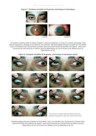 © UMVF - Université Médicale Virtuelle Francophone
Figure 7 : Paralysie complète du III gauche, extrinsèque et intrinsèque
En position primaire existe un ptosis complet (« ptosis providentiel »), lorsqu’on soulève la paupière, l’œil
gauche apparaît en divergence et présente une mydriase. Ophtalmoplégie presque complète de l’œil atteint,
avec une limitation des mouvements oculaires dans quasiment toutes les positions du regard ; seuls sont
conservés les mouvements en dehors (sous la dépendance du VI) et en bas et en dedans (sous la
dépendance du IV).
Figure 8 : Paralysie complète du III gauche, extrinsèque et intrinsèque (suite)
Ophtalmoplégie presque complète de l’oeil atteint, avec une limitation des mouvements oculaires dans
quasiment toutes les positions du regard ; seuls sont conservés les mouvements en dehors (sous la
dépendance du VI) et en bas et en dedans (sous la dépendance du IV).
11
 