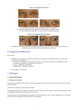 © UMVF - Université Médicale Virtuelle Francophone
Figure 9 : Paralysie du VI droit
A : en position primaire, l’œil droit paralysé est en convergence.
B : abolition complète de l’abduction de l’œil droit dans le regard à droite.
C : conservation de l’adduction de l’œil droit dans le regard à gauche.
Figure 10 : Paralysie interernucléaire
Le parallélisme des deux yeux est conservé en position primaire (a), mais il existe une limitation de
l’adduction de l’oeil droit dans le regard latéral gauche (b).
6. Diagnostic différentiel
Il peut s’agir :
● de diplopie monoculaire. La diplopie disparaît avec l’occlusion de l’œil pathologique. Il peut s’agir
notamment d’une atteinte :
○ cornéenne par diffraction des rayons lumineux : taie cornéenne séquelle d’une kératite ou d’un
traumatisme, kératocône, astigmatisme important,
○ irienne : iridodialyse traumatique,
○ cristallinienne : cataracte nucléaire ;
● de simulation et d’hystérie.
7. Etiologie
1. Causes traumatiques
→ Fractures de l’orbite
Les fractures du plancher de l’orbite, avec hernie graisseuse et musculaire dans le foyer de fracture, sont les
plus fréquentes.
L’élévation du globe est douloureuse et limitée.
La mobilisation passive du globe par traction du droit inférieur (test de duction forcée) est impossible du fait
du blocage du droit inférieur dans le trait de fracture.
Les explorations neuroradiologiques visualisent le trait de fracture, voire la hernie graisseuse et musculaire
sous forme d’une image en goutte dans le sinus maxillaire.
12
 