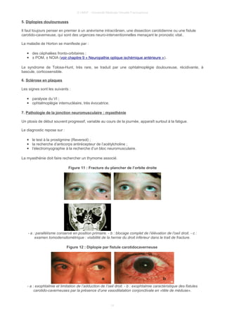 © UMVF - Université Médicale Virtuelle Francophone
5. Diplopies douloureuses
Il faut toujours penser en premier à un anévrisme intracrânien, une dissection carotidienne ou une fistule
carotido-caverneuse, qui sont des urgences neuro-interventionnelles menaçant le pronostic vital..
La maladie de Horton se manifeste par :
● des céphalées fronto-orbitaires ;
● ± POM, ± NOIA (voir chapitre 9 « Neuropathie optique ischémique antérieure »).
Le syndrome de Tolosa-Hunt, très rare, se traduit par une ophtalmoplégie douloureuse, récidivante, à
bascule, corticosensible.
6. Sclérose en plaques
Les signes sont les suivants :
● paralysie du VI ;
● ophtalmoplégie internucléaire, très évocatrice.
7. Pathologie de la jonction neuromusculaire : myasthénie
Un ptosis de début souvent progressif, variable au cours de la journée, apparaît surtout à la fatigue.
Le diagnostic repose sur :
● le test à la prostigmine (Reversol) ;
● la recherche d’anticorps antirécepteur de l’acétylcholine ;
● l’électromyographie à la recherche d’un bloc neuromusculaire.
La myasthénie doit faire rechercher un thymome associé.
Figure 11 : Fracture du plancher de l’orbite droite
- a : parallélisme conservé en position primaire. - b : blocage complet de l’élévation de l’oeil droit. - c :
examen tomodensitométrique : visibilité de la hernie du droit inférieur dans le trait de fracture.
Figure 12 : Diplopie par fistule carotidocaverneuse
- a : exophtalmie et limitation de l’adduction de l’oeil droit. - b : exophtalmie caractéristique des fistules
carotido-caverneuses par la présence d’une vasodilatation conjonctivale en «tête de méduse».
14
 