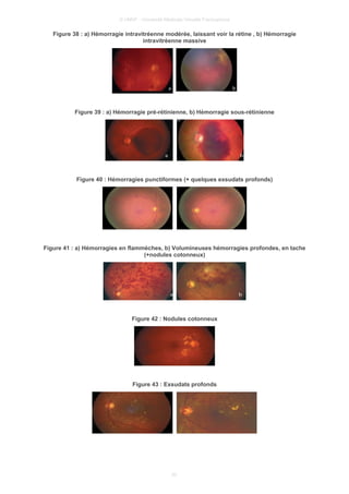 © UMVF - Université Médicale Virtuelle Francophone
Figure 38 : a) Hémorragie intravitréenne modérée, laissant voir la rétine , b) Hémorragie
intravitréenne massive
Figure 39 : a) Hémorragie pré-rétinienne, b) Hémorragie sous-rétinienne
Figure 40 : Hémorragies punctiformes (+ quelques exsudats profonds)
Figure 41 : a) Hémorragies en flammèches, b) Volumineuses hémorragies profondes, en tache
(+nodules cotonneux)
Figure 42 : Nodules cotonneux
Figure 43 : Exsudats profonds
20
 