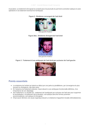 © UMVF - Université Médicale Virtuelle Francophone
musculaire. Le traitement chirurgical ne surseoit pas à la poursuite du port de la correction optique en post-
opératoire ni du traitement éventuel de l'amblyopie.
Figure 2 : Strabisme convergent de l’oeil droit
Oeil gauche fixateur.
Figure 2bis : Strabisme divergent de l’oeil droit
Oeil gauche fixateur.
Figure 3 : Traitement d’une amblyopie de l’oeil droit par occlusion de l’oeil gauche
Points essentiels
● Le strabisme de l’enfant se traduit au début par une perte du parallélisme, par convergence le plus
souvent ou divergence, des deux yeux.
● En l’absence de traitement précoce, il peut aboutir à une amblyopie fonctionnelle déﬁnitive, d’où
l’importance de son dépistage.
● Son traitement a un double but : traitement de l’amblyopie par occlusion de l’œil sain pour supprimer
la neutralisation, et traitement de la déviation, soit optique dans les formes purement
accommodatives, soit optique et chirurgical.
● Il faut savoir éliminer une cause organique devant un strabisme d’apparition brutale (rétinoblastome).
7
 