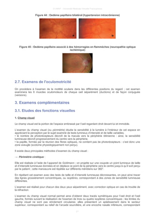 © UMVF - Université Médicale Virtuelle Francophone
Figure 44 : Oedème papillaire bilatéral (hypertension intracrânienne)
Figure 45 : Oedème papillaire associé à des hémorragies en flammèches (neuropathie optique
ischémique)
2.7. Examens de l'oculomotricité
On procédera à l’examen de la motilité oculaire dans les différentes positions du regard ; cet examen
examinera les 6 muscles oculomoteurs de chaque oeil séparément (ductions) et de façon conjuguée
(versions).
3. Examens complémentaires
3.1. Etudes des fonctions visuelles
1. Champ visuel
Le champ visuel est la portion de l’espace embrassé par l’oeil regardant droit devant lui et immobile.
L’examen du champ visuel (ou périmétrie) étudie la sensibilité à la lumière à l’intérieur de cet espace en
appréciant la perception par le sujet examiné de tests lumineux d’intensité et de taille variables.
• le nombre de photorécepteurs décroît de la macula vers la périphérie rétinienne : ainsi, la sensibilité
lumineuse décroît progressivement du centre vers la périphérie.
• la papille, formée par la réunion des fibres optiques, ne contient pas de photorécepteurs : c’est donc une
zone aveugle (scotome physiologiquement non perçu).
Il existe deux principales méthodes d’examen du champ visuel :
→ Périmétrie cinétique :
Elle est réalisée à l’aide de l’appareil de Goldmann ; on projette sur une coupole un point lumineux de taille
et d’intensité lumineuse données et on déplace ce point de la périphérie vers le centre jusqu’à qu’il soit perçu
par le patient ; cette manoeuvre est répétée sur différents méridiens sur 360°.
En répétant cet examen avec des tests de taille et d’intensité lumineuse décroissantes, on peut ainsi tracer
des lignes grossièrement concentriques, ou isoptères, correspondant à des zones de sensibilité lumineuse
différentes.
L’examen est réalisé pour chacun des deux yeux séparément, avec correction optique en cas de trouble de
la réfraction.
L’examen du champ visuel normal permet ainsi d’obtenir deux tracés symétriques pour l’oeil droit et l’oeil
gauche, formés suivant la réalisation de l’examen de trois ou quatre isoptères concentriques ; les limites du
champ visuel ne sont pas strictement circulaires: elles présentent un aplatissement dans le secteur
supérieur, correspondant au relief de l’arcade sourcilière, et une encoche nasale inférieure, correspondant
21
 