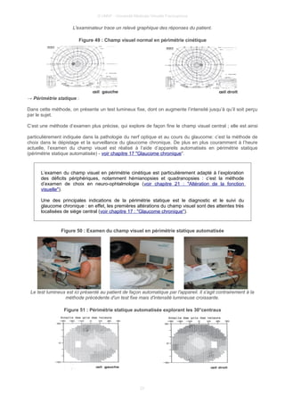 © UMVF - Université Médicale Virtuelle Francophone
L'examinateur trace un relevé graphique des réponses du patient.
Figure 49 : Champ visuel normal en périmétrie cinétique
→ Périmétrie statique :
Dans cette méthode, on présente un test lumineux fixe, dont on augmente l’intensité jusqu’à qu’il soit perçu
par le sujet.
C’est une méthode d’examen plus précise, qui explore de façon fine le champ visuel central ; elle est ainsi
particulièrement indiquée dans la pathologie du nerf optique et au cours du glaucome: c’est la méthode de
choix dans le dépistage et la surveillance du glaucome chronique. De plus en plus couramment à l’heure
actuelle, l’examen du champ visuel est réalisé à l’aide d’appareils automatisés en périmétrie statique
(périmétrie statique automatisée) - voir chapitre 17 "Glaucome chronique".
L’examen du champ visuel en périmétrie cinétique est particulièrement adapté à l’exploration
des déficits périphériques, notamment hémianopsies et quadranopsies : c’est la méthode
d’examen de choix en neuro-ophtalmologie (voir chapitre 21 : "Altération de la fonction
visuelle").
Une des principales indications de la périmétrie statique est le diagnostic et le suivi du
glaucome chronique : en effet, les premières altérations du champ visuel sont des atteintes très
localisées de siège central (voir chapitre 17 : "Glaucome chronique").
Figure 50 : Examen du champ visuel en périmétrie statique automatisée
Le test lumineux est ici présenté au patient de façon automatique par l'appareil. Il s'agit contrairement à la
méthode précédente d'un test fixe mais d'intensité lumineuse croissante.
Figure 51 : Périmétrie statique automatisée explorant les 30°centraux
23
 