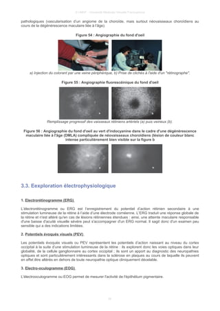 © UMVF - Université Médicale Virtuelle Francophone
pathologiques (vascularisation d’un angiome de la choroïde, mais surtout néovaisseaux choroïdiens au
cours de la dégénérescence maculaire liée à l’âge).
Figure 54 : Angiographie du fond d'oeil
a) Injection du colorant par une veine périphérique, b) Prise de clichés à l'aide d'un "rétinographe".
Figure 55 : Angiographie fluorescéinique du fond d'oeil
Remplissage progressif des vaisseaux rétiniens artériels (a) puis veineux (b).
Figure 56 : Angiographie du fond d'oeil au vert d'indocyanine dans le cadre d'une dégénérescence
maculaire liée à l'âge (DMLA) compliquée de néovaisseaux choroïdiens (lésion de couleur blanc
intense particulièrement bien visible sur la figure b
3.3. Eexploration électrophysiologique
1. Electrorétinogramme (ERG)
L’électrorétinogramme ou ERG est l’enregistrement du potentiel d’action rétinien secondaire à une
stimulation lumineuse de la rétine à l’aide d’une électrode cornéenne. L’ERG traduit une réponse globale de
la rétine et n'est altéré qu'en cas de lésions rétiniennes étendues : ainsi, une atteinte maculaire responsable
d'une baisse d'acuité visuelle sévère peut s'accompagner d'un ERG normal. Il sagit donc d'un examen peu
sensible qui a des indications limitées.
2. Potentiels évoqués visuels (PEV)
Les potentiels évoqués visuels ou PEV représentent les potentiels d’action naissant au niveau du cortex
occipital à la suite d’une stimulation lumineuse de la rétine : ils explorent donc les voies optiques dans leur
globalité, de la cellule ganglionnaire au cortex occipital ; ils sont un apport au diagnostic des neuropathies
optiques et sont particulièrement intéressants dans la sclérose en plaques au cours de laquelle ils peuvent
en effet être altérés en dehors de toute neuropathie optique cliniquement décelable.
3. Electro-oculogramme (EOG)
L'électrooculogramme ou EOG permet de mesurer l'activité de l'épithélium pigmentaire.
25
 