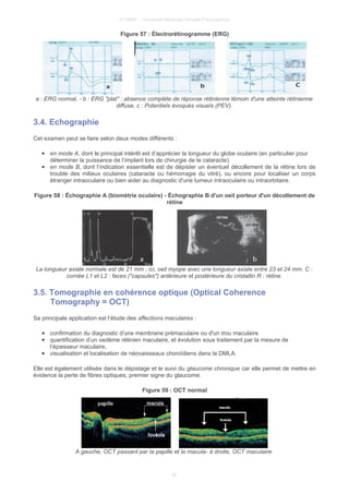 © UMVF - Université Médicale Virtuelle Francophone
Figure 57 : Électrorétinogramme (ERG)
a : ERG normal, - b : ERG "plat" : absence complète de réponse rétinienne témoin d'une atteinte rétinienne
diffuse, c : Potentiels évoqués visuels (PEV).
3.4. Echographie
Cet examen peut se faire selon deux modes différents :
● en mode A, dont le principal intérêt est d’apprécier la longueur du globe oculaire (en particulier pour
déterminer la puissance de l’implant lors de chirurgie de la cataracte).
● en mode B, dont l’indication essentielle est de dépister un éventuel décollement de la rétine lors de
trouble des milieux oculaires (cataracte ou hémorragie du vitré), ou encore pour localiser un corps
étranger intraoculaire ou bien aider au diagnostic d'une tumeur intraoculaire ou intraorbitaire.
Figure 58 : Échographie A (biométrie oculaire) - Échographie B d'un oeil porteur d'un décollement de
rétine
La longueur axiale normale est de 21 mm ; ici, oeil myope avec une longueur axiale entre 23 et 24 mm. C :
cornée L1 et L2 : faces ("capsules") antérieure et postérieure du cristallin R : rétine.
3.5. Tomographie en cohérence optique (Optical Coherence
Tomography = OCT)
Sa principale application est l’étude des affections maculaires :
● confirmation du diagnostic d'une membrane prémaculaire ou d'un trou maculaire
● quantification d’un oedème rétinien maculaire, et évolution sous traitement par la mesure de
l’épaisseur maculaire,
● visualisation et localisation de néovaisseaux choroïdiens dans la DMLA.
Elle est également utilisée dans le dépistage et le suivi du glaucome chronique car elle permet de mettre en
évidence la perte de fibres optiques, premier signe du glaucome.
Figure 59 : OCT normal
A gauche, OCT passant par la papille et la macula- à droite, OCT maculaire.
26
 