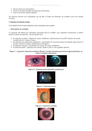 © UMVF - Université Médicale Virtuelle Francophone
● œil par œil puis en binoculaire ;
● de loin et de près (échelles de Monoyer et Parinaud) ;
● avec la correction optique adaptée.
On retrouve souvent une myopisation qui est liée à l’indice de réfraction du cristallin (c’est une myopie
d’indice).
3. Examen à la lampe à fente
Il est réalisé avant et après dilatation pharmacologique des pupilles.
→ Description du cristallin
La cataracte est définie par l’apparition d’opacités dans le cristallin. Leur répartition anatomique va définir
plusieurs types de cataracte. Les principales sont :
● la cataracte nucléaire : atteinte du noyau cristallinien, prédominance d’une BAV (baisse de l’acuité
visuelle) de loin, myopie d’indice ;
● la cataracte sous-capsulaire postérieure : opacification en soucoupe devant la capsule, gêne de loin et
de près. Penser à l’origine métabolique et iatrogène ;
● la cataracte corticale : opacification au niveau du cortex cristallinien ;
● la cataracte totale : cataracte très évoluée visible à l’œil nu, aire pupillaire blanche.
Figure 1 : A gauche, Cataracte nucléaire (flèche), à droite Volumineuses hémorragies profondes, en
tache (+nodules cotonneux)
Figure 2 : Cataracte sous-capsulaire postérieure
Figure 3 : Cataracte brune
Figure 4 : Cataracte corticale
4
 