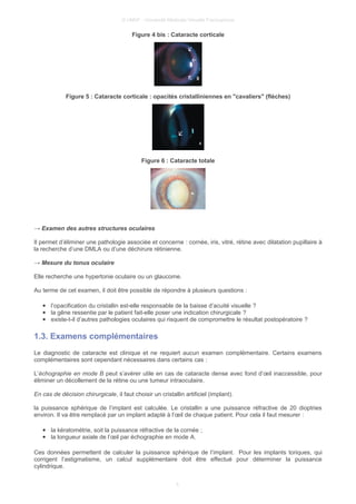 © UMVF - Université Médicale Virtuelle Francophone
Figure 4 bis : Cataracte corticale
Figure 5 : Cataracte corticale : opacités cristalliniennes en "cavaliers" (flèches)
Figure 6 : Cataracte totale
→ Examen des autres structures oculaires
Il permet d’éliminer une pathologie associée et concerne : cornée, iris, vitré, rétine avec dilatation pupillaire à
la recherche d’une DMLA ou d’une déchirure rétinienne.
→ Mesure du tonus oculaire
Elle recherche une hypertonie oculaire ou un glaucome.
Au terme de cet examen, il doit être possible de répondre à plusieurs questions :
● l’opacification du cristallin est-elle responsable de la baisse d’acuité visuelle ?
● la gêne ressentie par le patient fait-elle poser une indication chirurgicale ?
● existe-t-il d’autres pathologies oculaires qui risquent de compromettre le résultat postopératoire ?
1.3. Examens complémentaires
Le diagnostic de cataracte est clinique et ne requiert aucun examen complémentaire. Certains examens
complémentaires sont cependant nécessaires dans certains cas :
L’échographie en mode B peut s’avérer utile en cas de cataracte dense avec fond d’œil inaccessible, pour
éliminer un décollement de la rétine ou une tumeur intraoculaire.
En cas de décision chirurgicale, il faut choisir un cristallin artificiel (implant).
la puissance sphérique de l’implant est calculée. Le cristallin a une puissance réfractive de 20 dioptries
environ. Il va être remplacé par un implant adapté à l’œil de chaque patient. Pour cela il faut mesurer :
● la kératométrie, soit la puissance réfractive de la cornée ;
● la longueur axiale de l’œil par échographie en mode A.
Ces données permettent de calculer la puissance sphérique de l’implant. Pour les implants toriques, qui
corrigent l’astigmatisme, un calcul supplémentaire doit être effectué pour déterminer la puissance
cylindrique.
5
 