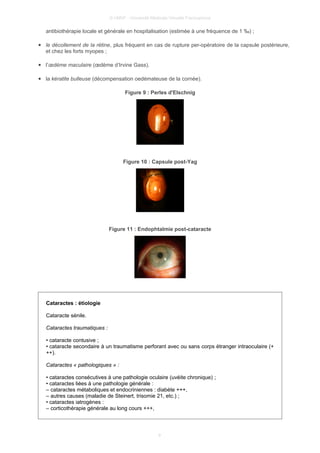 © UMVF - Université Médicale Virtuelle Francophone
antibiothérapie locale et générale en hospitalisation (estimée à une fréquence de 1 ‰) ;
● le décollement de la rétine, plus fréquent en cas de rupture per-opératoire de la capsule postérieure,
et chez les forts myopes ;
● l’œdème maculaire (œdème d’Irvine Gass).
● la kératite bulleuse (décompensation oedémateuse de la cornée).
Figure 9 : Perles d'Elschnig
Figure 10 : Capsule post-Yag
Figure 11 : Endophtalmie post-cataracte
Cataractes : étiologie
Cataracte sénile.
Cataractes traumatiques :
• cataracte contusive ;
• cataracte secondaire à un traumatisme perforant avec ou sans corps étranger intraoculaire (+
++).
Cataractes « pathologiques » :
• cataractes consécutives à une pathologie oculaire (uvéite chronique) ;
• cataractes liées à une pathologie générale :
– cataractes métaboliques et endocriniennes : diabète +++,
– autres causes (maladie de Steinert, trisomie 21, etc.) ;
• cataractes iatrogènes :
– corticothérapie générale au long cours +++,
9
 