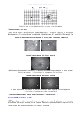 © UMVF - Université Médicale Virtuelle Francophone
Figure 1 : Grille d’Amsler
A gauche, sujet normal ; à droite, scotome central et métamorphopsies.
3. Angiographie du fond d’oeil
C’est la prise de clichés du fond d’oeil après injection intraveineuse d’un colorant fluorescent, le plus souvent
la fluorescéine. L'angiographie au vert d’indocyanine peut être utilisée en complément dans certains cas.
Figure 2 : Angiographie fluorescéinique de néovaisseaux choroïdiens bien définis
Figure 3 : Néovaisseaux choroïdiens profonds
Mal définis sur l’angiographie fluorescéinique (a), formant une plaque hyperfluorescente au temps tardif de
l’angiographie au vert d’indocyanine (c). a : angiographie fluorescéinique.
Figure 4 : Néovaisseaux choroïdiens profonds
b : temps précoce de l’angiographie au vert d’indocyanine c : temps tardif de l’angiographie au vert
d’indocyanine : néovaisseau choroïdien étendu (flèche).
4. Tomographie à cohérence optique (Optical Coherence Tomography (OCT))
Voir le chapitre 1 : "Sémiologie oculaire".
L’OCT permet de visualiser, sur des images en coupe de la macula, la présence de néovaisseaux
choroïdiens et leurs signes associés, tels que l'oedème maculaire ou le décollement exsudatif de la macula.
Elle est souvent utilisée seule pour suivre l'évolution sous traitement.
5
 