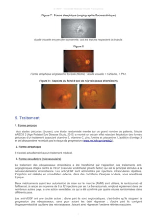 © UMVF - Université Médicale Virtuelle Francophone
Figure 7 : Forme atrophique (angiographie fluorescéinique)
Acuité visuelle encore bien conservée, cas les lésions respectent la fovéola.
Figure 8
Forme atrophique englobant la fovéola (flèche) ; acuité visuelle < 1/20ème, < P14.
Figure 9 : Aspects du fond d’oeil de néovaisseaux choroïdiens
5. Traitement
1. Forme précoce
Aux stades précoces (drusen), une étude randomisée menée sur un grand nombre de patients, l’étude
AREDS 2 (Age Related Eye Disease Study, 2013) a montré un certain effet retardant l’évolution des formes
précoces d’un traitement associant vitamine E, vitamine C, zinc, lutéine et zéaxantine. L'addition d'oméga 3
et de bêtacarotène ne réduit pas le risque de progression (www.nei.nih.gov/areds2/).
2. Forme atrophique
Il n’existe actuellement aucun traitement médical.
3. Forme exsudative (néovasculaire)
Le traitement des néovaisseaux choroïdiens a été transformé par l'apparition des traitements anti-
angiogéniques dirigés contre le VEGF (vascular endothelial growth factor) qui est le principal stimulus à la
néovascularisation choroïdienne. Les anti-VEGF sont administrés par injections intraoculaires répétées.
L'injection est réalisée en consultation externe, dans des conditions d'asepsie oculaire, sous anesthésie
topique.
Deux médicaments ayant leur autorisation de mise sur le marché (AMM) sont utilisés, le ranibizumab et
l'aflibercet, à raison en moyenne de 6 à 12 injections par an. Le bevacizumab, employé également dans de
nombreux autres pays, a une action semblable, ce qui a été confirmé par quatre études randomisées dans
différents pays.
Les anti-VEGF ont une double action : d'une part ils sont angiostatiques, c'est-à-dire qu'ils stoppent la
progression des néovaisseaux, sans pour autant les faire régresser ; d'autre part ils corrigent
l'hyperperméabilité capillaire des néovaisseaux ; faisant ainsi régresser l'oedème rétinien maculaire.
7
 