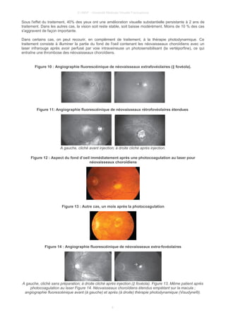 © UMVF - Université Médicale Virtuelle Francophone
Sous l'effet du traitement, 40% des yeux ont une amélioration visuelle substantielle persistante à 2 ans de
traitement. Dans les autres cas, la vision soit reste stable, soit baisse modérément. Moins de 10 % des cas
s'aggravent de façon importante.
Dans certains cas, on peut recourir, en complément de traitement, à la thérapie photodynamique. Ce
traitement consiste à illuminer la partie du fond de l'oeil contenant les néovaisseaux choroïdiens avec un
laser infrarouge après avoir perfusé par voie intraveineuse un photosensibilisant (la vertéporfine), ce qui
entraîne une thrombose des néovaisseaux choroïdiens.
Figure 10 : Angiographie fluorescéinique de néovaisseaux extrafovéolaires (‡ fovéola).
Figure 11: Angiographie fluorescéinique de néovaisseaux rétrofovéolaires étendues
A gauche, cliché avant injection; à droite cliché après injection.
Figure 12 : Aspect du fond d’oeil immédiatement après une photocoagulation au laser pour
néovaisseaux choroïdiens
Figure 13 : Autre cas, un mois après la photocoagulation
Figure 14 : Angiographie fluorescéinique de néovaisseaux extra-fovéolaires
A gauche, cliché sans préparation; à droite cliché après injection (‡ fovéola). Figure 13. Même patient après
photocoagulation au laser Figure 14. Néovaisseaux choroïdiens étendus empiétant sur la macula ;
angiographie fluorescéinique avant (à gauche) et après (à droite) thérapie photodynamique (Visudyne®).
8
 